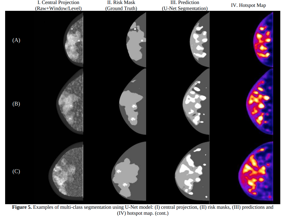 Multiclass segmentation of suspicious findings in simulated breast tomosynthesis images using a U-Net