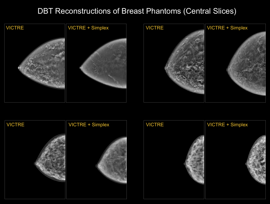 Representation of complex mammary parenchyma texture in tomosynthesis using simplex noise simulations