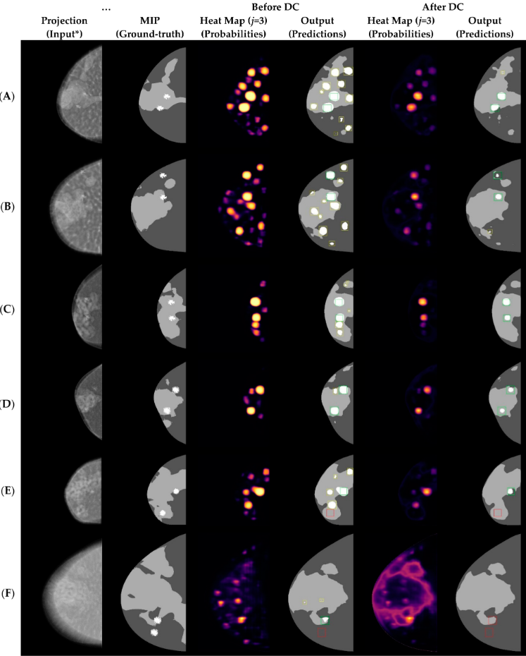 Multiclass Segmentation of Breast Tissue and Suspicious Findings: A Simulation-Based Study for the Development of Self-Steering Tomosynthesis